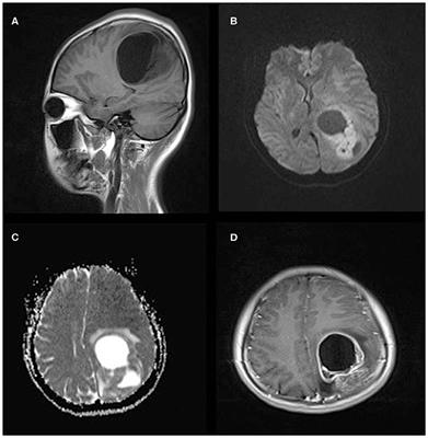 MRI Features of Intracranial Anaplastic Ependymomas: A Comparison of Supratentorial and Infratentorial Lesions